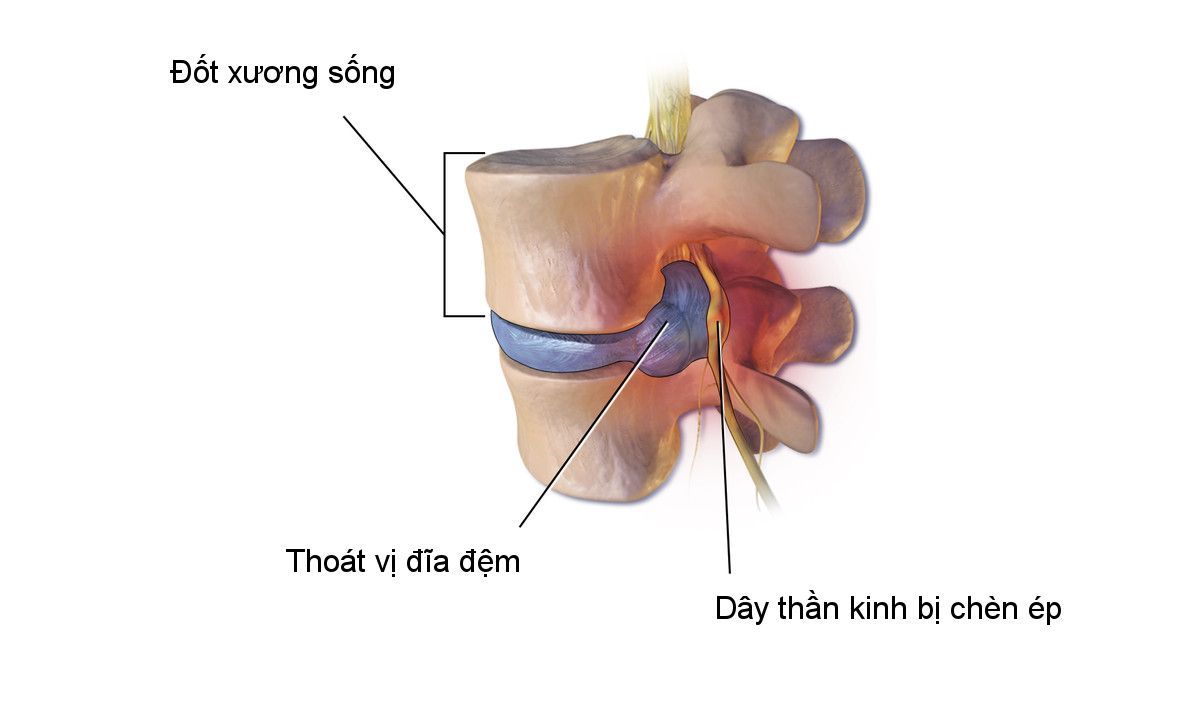 thoat-vi-dia-dem-co-nguy-hiem-khong-2