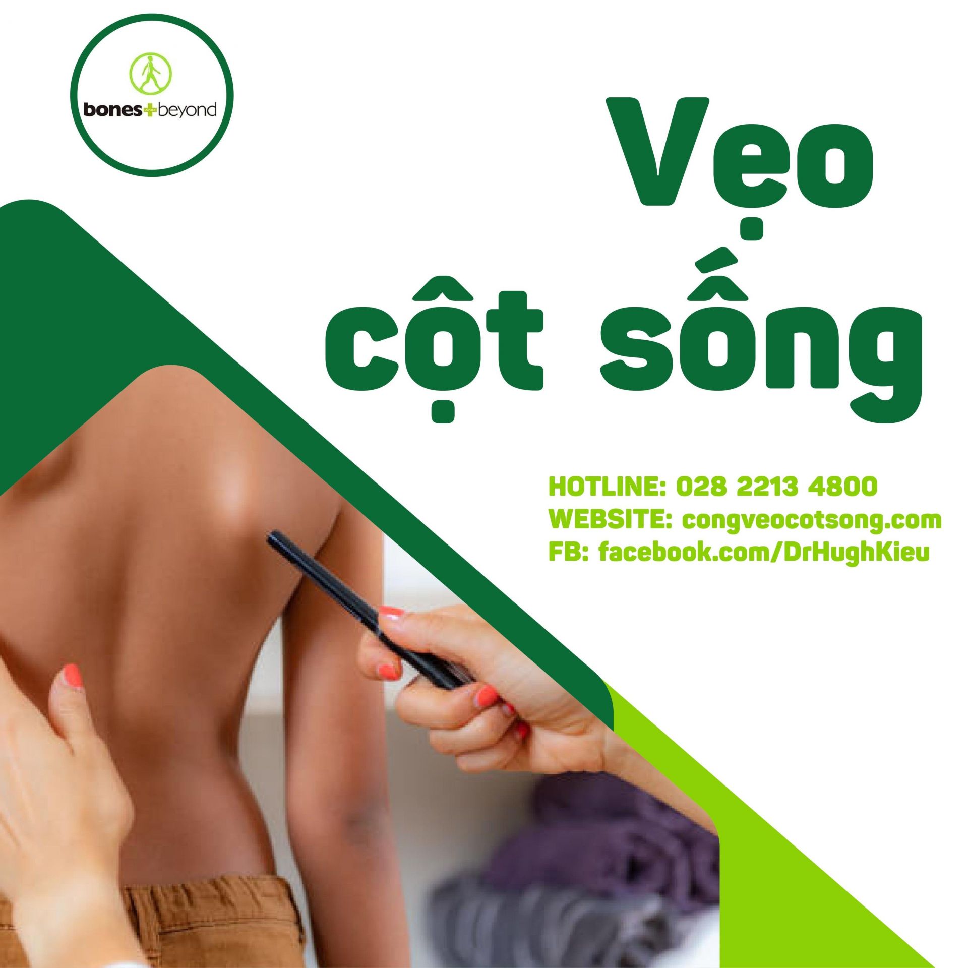 Cong vẹo cột sống - Tất Cả Những Gì Bạn Cần Biết về Nguyên Nhân, Triệu Chứng, Điều Trị và Phòng Ngừa