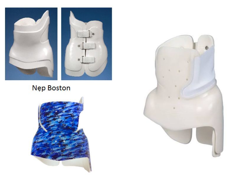 Nẹp Boston (Boston Brace)