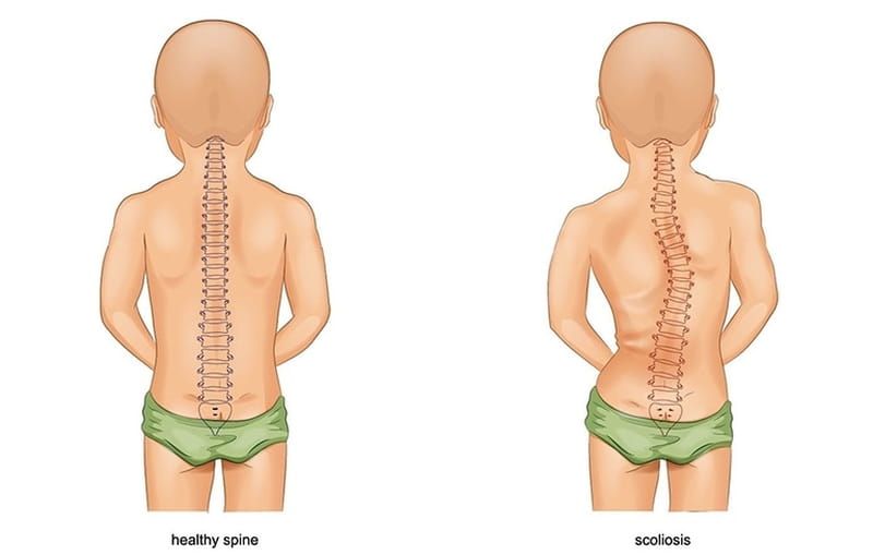 Cách chữa vẹo cột sống ở trẻ em