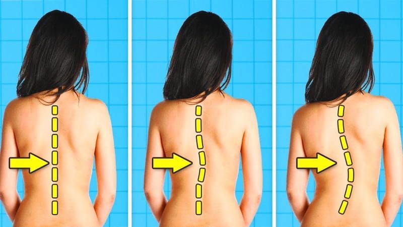 Cách chữa vẹo cột sống ở người lớn
