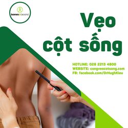 Cong vẹo cột sống - Tất Cả Những Gì Bạn Cần Biết về Nguyên Nhân, Triệu Chứng, Điều Trị và Phòng Ngừa