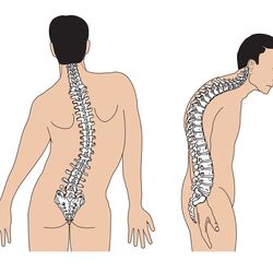 Nguyên nhân và các triệu chứng của cong vẹo cột sống