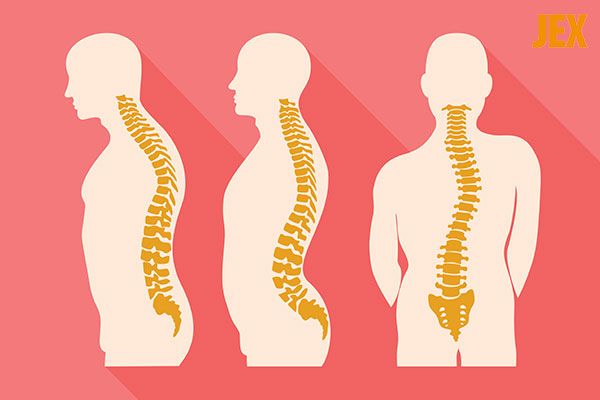 Cong vẹo cột sống có nguy hiểm không?