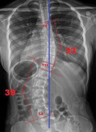 scoliosis-spine-xray_-_copy_copy---copy