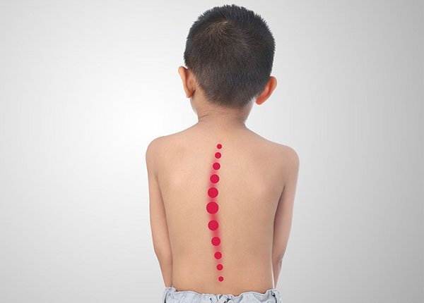 Cong vẹo cột sống trẻ em