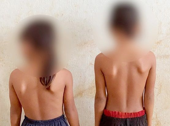 TRẺ EM BỊ CONG VẸO CỘT SỐNG