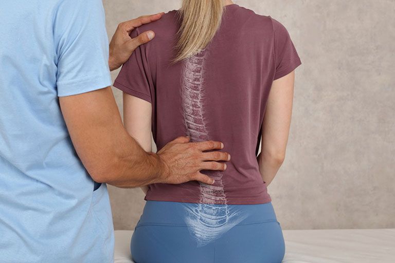 Nguyên Nhân Và Cách Khắc Phục Tình Trạng Cong Vẹo Cột Sống Bạn Nên Biết