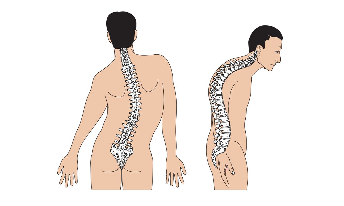 Nguyên nhân và các triệu chứng của cong vẹo cột sống