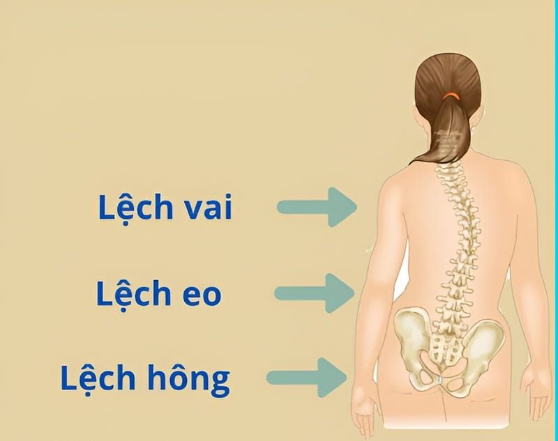 Khắc phục lệch hông