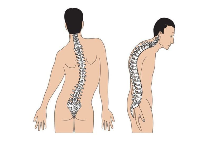 Lệch Xương Chậu