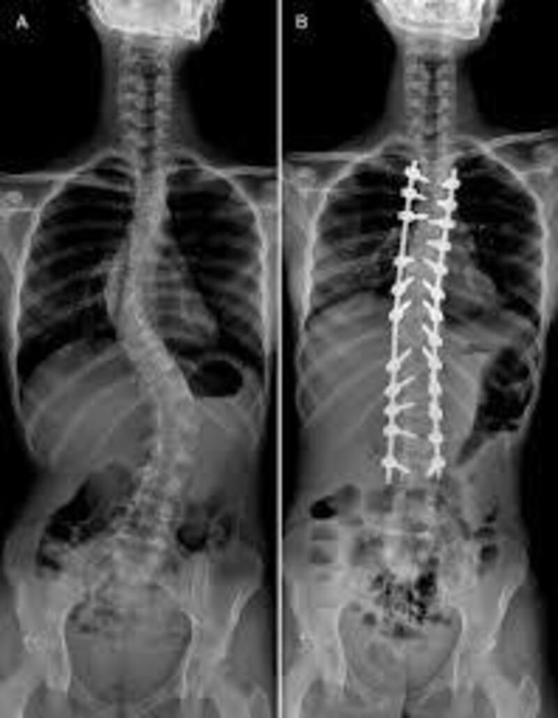 Hướng tiếp cận an toàn cho người bị cong vẹo cột sống muốn mang thai 