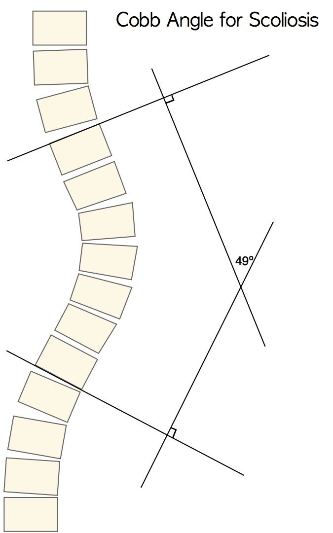 cobb-method-_-cobb-method-scoliosis-_-cobb-technique