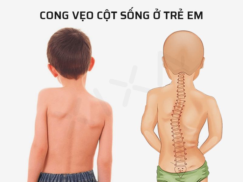 Dấu Hiệu Nhận Biết Trẻ Bị Cong Vẹo Cột Sống