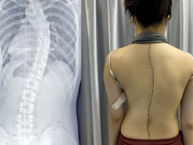 Trẻ Bị Cong Vẹo Cột Sống Có Ảnh Hưởng Gì Nếu Không Điều Trị?