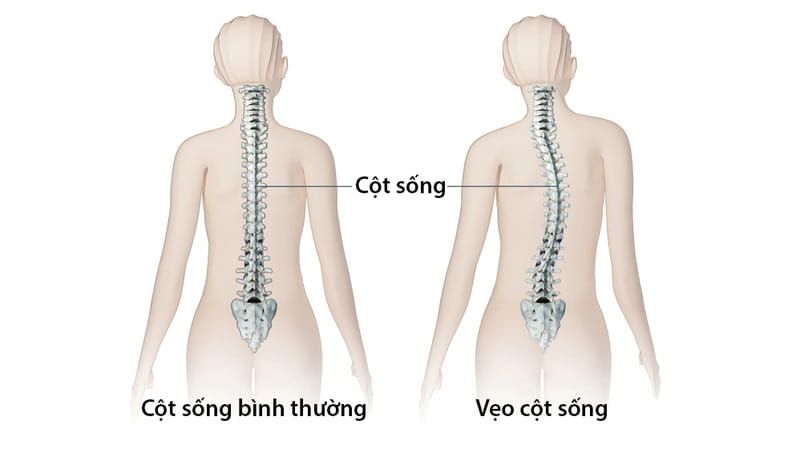 Cột sống cong hoặc cơ thể nghiêng sang một bên