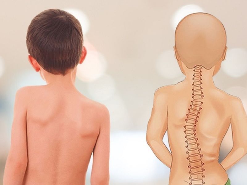 Vẹo Cột Sống 10 Độ Ở Trẻ Em