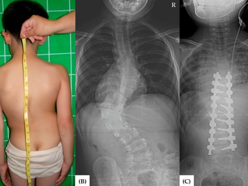 Nguyên Nhân Gây Vẹo Cột Sống Bẩm Sinh