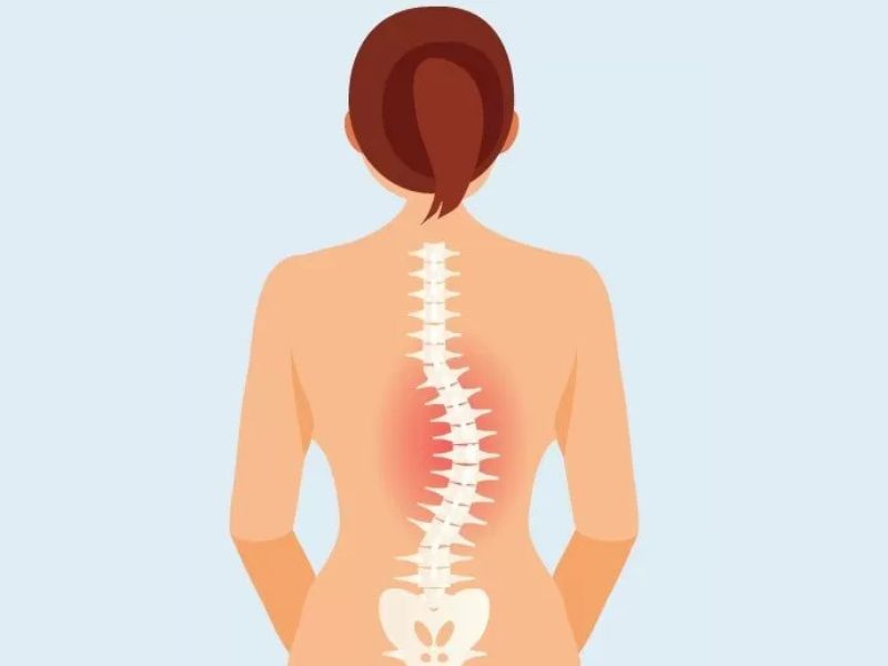 Vẹo Cột Sống Chữ C Là Gì?